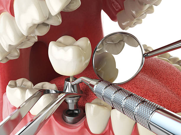 Best Broken or Chipped Tooth Repair in Bushland, TX